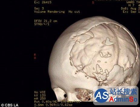 3D打印超仿生头盖骨：7岁小孩重获生命力